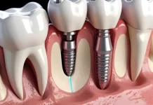 Secure, Comfortable, and Natural: The Magic of Dental Implants